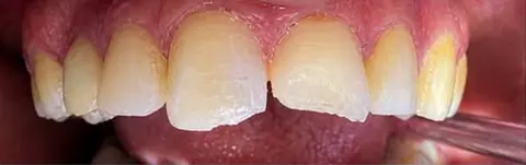 Antes: dente da frente lascado na ponta