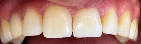 Depois: dentes restaurados em resina composta