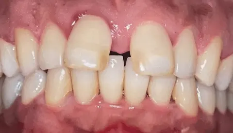 Antes: dentes da frente separados e desalinhados