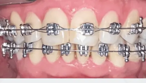 Durante: os mesmos dentes já alinhados com aparelho fixo