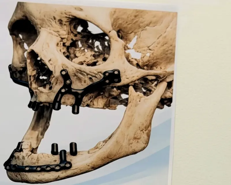 Planejamento 3D de uma reconstrução da mandíbula, com as placas de fixação desenhadas no crânio
