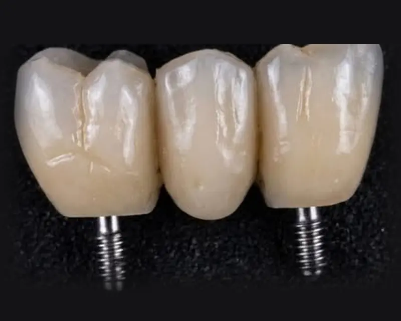 Ponte de três dentes em cerâmica sobre dois implantes
