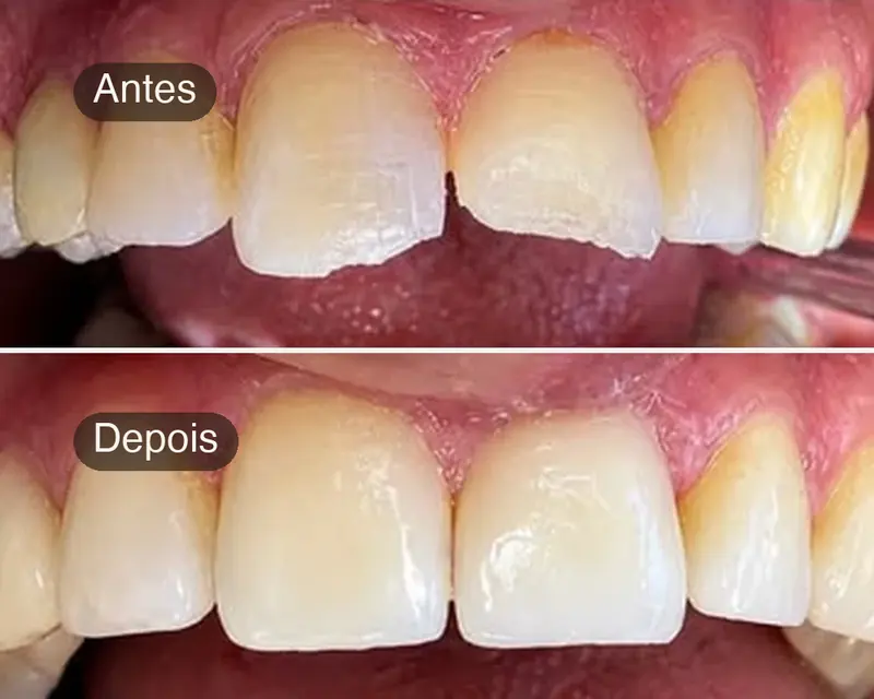 Antes e depois de dentes da frente lascados, restaurados em resina